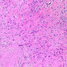 Malignant means they are capable in comparison to epithelial cells, sarcomatoid cells have a distinctive, elongated spindle shape that. Mesothelioma An Overview Sciencedirect Topics