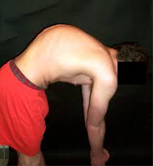 There exist different muscles, which we have covered in class over the past few wee. Kyphosis Wikipedia