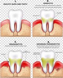 Four Tooth Chart Periodontitis Disease Gums Periodontology