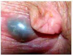 Este procedimiento, realizado bajo anestesia local, es más eficaz si se realiza dentro de las 72 horas de que haya aparecido un coágulo. Universo Enarm Paciente Masculino De 29 Anos El Cual Acude A Urgencias Por Presentar Dolor Anal El Cual Se Exacerba Al Sentarse A La Exploracion Fisica Se Encuentra Una Tumoracion Azulada