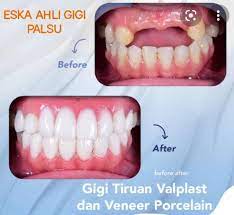 Klik sini untuk mengetahui lebih lanjut dan mula hidup bebas hari ini! Ahli Gigi Palsu Eska Surabaya Sidoarjo Startseite Facebook
