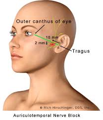 Image result for Ear Nerve Block