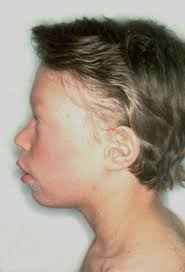 The Ichthyoses: The common thread in a life of investigation or Making a  professional life from the study and treatment of d