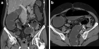 The lining of each tube, ileum and colon, is covered with mucosa and the appearance is health, not that of inflammation and such. Imaging The Operated Colon Using Water Enema Multidetector Ct With Emphasis On Surgical Anastomoses Insights Into Imaging Full Text