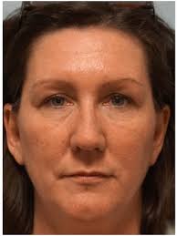Cases in Botox