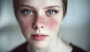 تُعتبر كلمة lupus واحدة من أبرز الكلمات التي كان لها الكثير من الاستخدام في المجال الطبي، خصوصاً وأنَّنا نتحدث عن وجود العديد الاستخدامات في الطب، ويأتي معنى كلمة lupus أنَّهُ مرض الذئبة وهو عبارة عن مرض. Ù†Ø³Ø§Ø¡ ÙŠØªØ­Ø¯ÙŠÙ† Ø§Ù„Ø°Ø¦Ø¨Ø© ÙˆØ¯ Ø§Ù„Ø¹Ø±ÙŠØ¨ÙŠ Ø­Ø§Ù„Ø§Øª ÙƒØ«ÙŠØ±Ø© ÙÙŠ Ø§Ù„Ø¨Ø­Ø±ÙŠÙ† ØµØ­ÙŠÙØ© Ø§Ù„ÙˆØ·Ù†