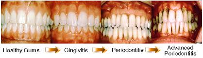 The following gingivitis definition comes straight from a medical dictionary: Gum Diseases S Relation To Other Diseases
