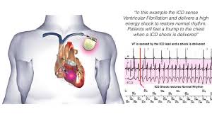 Image result for Internal Cardiac Defibrillator