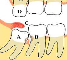 Dr choi goes over the answer. Wisdom Tooth Wikipedia