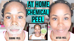 How To Make A Natural Chemical Peel At Home Erase Acne Wrinkles Dark Spots Youtube Chemical Peel Chemical Peel At Home Skin Peeling On Face