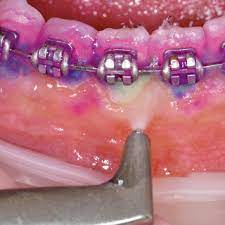 How to clean plaque off teeth with braces. The Orthodontic Patient From Hell To Heaven Ems Dental