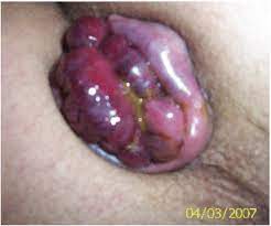 We did not find results for: What Do Hemorrhoids Look Like Crh O Regan System