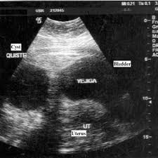 If you need surgery, your provider. Pdf A Rare Tumor Resembling Ovarian Cysts Mucocele Of The Appendix