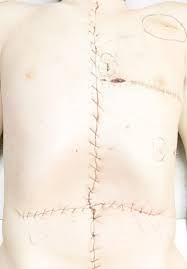 Photograph of anterior torso, demonstrating stab wounds (circled),... |  Download Scientific Diagram