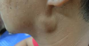 The photo here shows how many thyroid goiters look, which is like the neck is swolen and fat. Hpv Cancer Lymph Nodes Grandordeluxe Ro Hpv And Neck Lumps