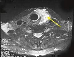 Ultrasonography of neck lymph nodes; Diagnosis Of Papillary Thyroid Cancer