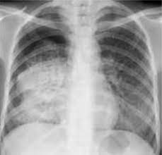 Case contributed by dr brenda lee solorzano frontal chest x ray shows bilateral micronodular insterstitial effusion. Tuberculosis Radiology Wikipedia