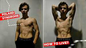 Poland syndrome is a rare, congenital condition characterized by a sunken or underdeveloped chest and hand abnormalities. 10 Advice For People With Poland Syndrome Motivation Video Youtube