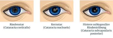 De eerste symptomen van cataracta corticalis of schorstroebeling zijn straalvormige vertroebelingen in het buitenste corticaal gedeelte van de lens. Grauer Star Katarakt Augenarzt Dr Robert Borny