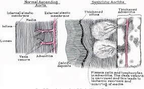 Image result for Cardiovascular Syphilis