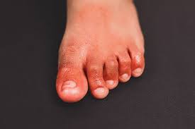 Some people are infected but don't. Do Covid 19 Symptoms Run Skin Deep Medpage Today
