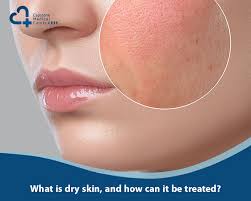 Image result for Dry Skin