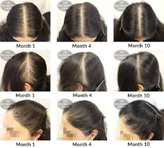 Hair growth journey pictures & stories from our members. Hair Growth Success My 9 Month Journey Has Been Amazing