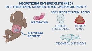 Image result for Necrotizing Enterocolitis