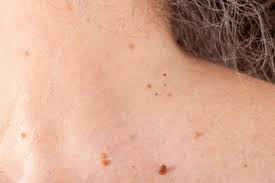 Skin Tags On Neck Causes How To Get Rid Of Them Skin Care Geeks