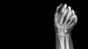 Image result for Hand Fracture