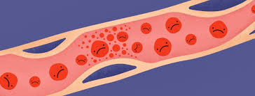 Bladder Cancer And Blood Clots Thromboembolism