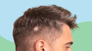 Image result for Alopecia