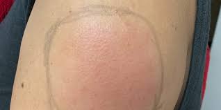 Us president joe biden urged 'optimism not relaxation' as he revealed america is well ahead of his vaccination goal of 100 million americans in his first 100 days in office. Covid Arm Rash After Moderna Vaccine Is Itchy But No Big Deal