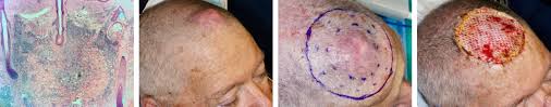 Merkel cell carcinoma treatment options include surgery, radiation therapy, and chemotherapy. Desmoplastic Spindle Cell Melanoma Of The Scalp Skin Cancer And Reconstructive Surgery Center