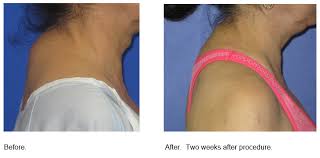 Synonyms for back of neck (other words and phrases for back of neck). Treating Dorsal Cervical Fat Or The Buffalo Hump Lopez Quita Aestheticlasercenter Com