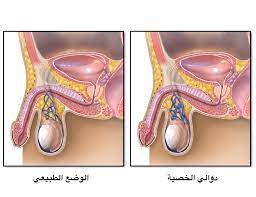 دوالي الخصية اسبابها انواعها والعمليات لعلاجها طب تايم