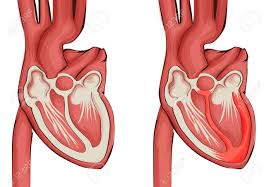 Por lo general es debida a una infección viral o bacteriana, y se presenta como dolor de pecho, signos repentinos de insuficiencia cardíaca y muerte súbita. Ilustracion Del Vector Del Corazon Miocarditis Sana Y Enferma Ilustraciones Vectoriales Clip Art Vectorizado Libre De Derechos Image 91473198