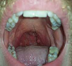 Effective treatment is possible in many cases. Throat Cancer Images Celine Dion Songs Age