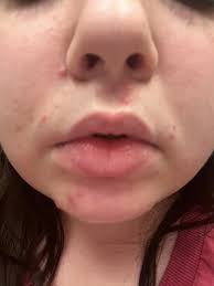 Acne around the mouth and chin area can be frustrating and affect  self-confidence. Since you're looking for non-insurance-related solutions