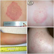 Image result for infected tick bite