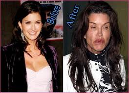 Top 25 Celebrities Before And After Plastic Surgery And Nose Jobs My Blog Bad Celebrity Plastic Surgery Celebrity Plastic Surgery Nose Plastic Surgery