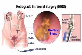 Laser Kidney Stone Treatment Delhi Click In