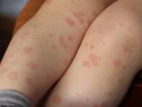 Симптомы нарастают медленнее заболевание продолжается до 6 недель. Otogennyj Sepsis Prichiny Simptomy Diagnostika I Lechenie