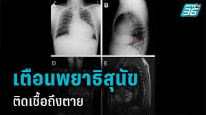 หัวใจโต ( cardiomegaly ) ภาวะหัวใจใหญ่กว่าปกติ ทำให้ความดันโลหิตสูง แต่หัวใจสูบฉีดเลือดได้ไม่ดี อาการเหนื่อยง่าย หายใจเร็ว เวียนหัว อ่อนเพลีย เท้า. à¸« à¸§à¹ƒà¸ˆà¹‚à¸• Pptvhd36