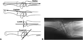 Image result for Scaphoid Shift Test