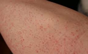 Some women, and men too, try everything in the book to stop ingrown hairs and nothing works. 10 Tips To Prevent Ingrown Hair