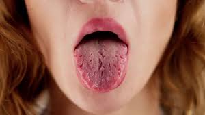 Image result for brown tongue symptoms