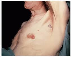 Grow under or around the nipple. Local Treatment Of Early Breast Cancer Oncohema Key
