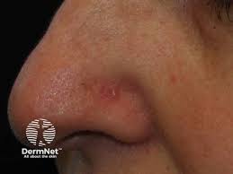 Image result for skin cancer on nose pimple