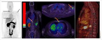 Find out how you have it. Axumin Pet Agent Added To Nccn Guidelines For Suspected Recurrent Prostate Cancer Imaging Technology News